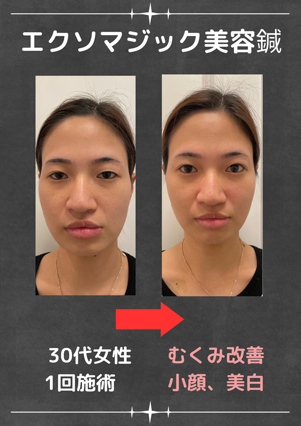 美容鍼のビフォーアフター(むくみ・フェイスライン)
