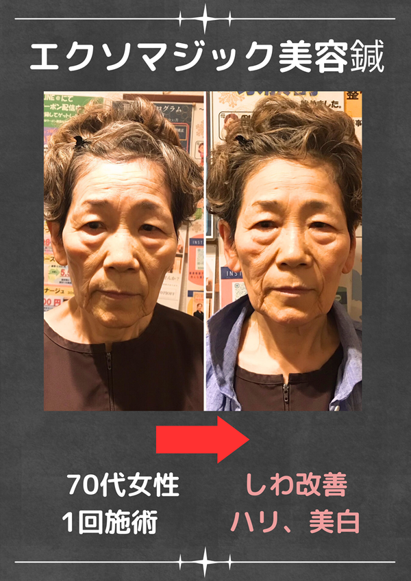 美容鍼のビフォーアフター(しわ改善・ハリ・美白)