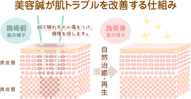 美容鍼が肌トラブルを改善する仕組みの図解