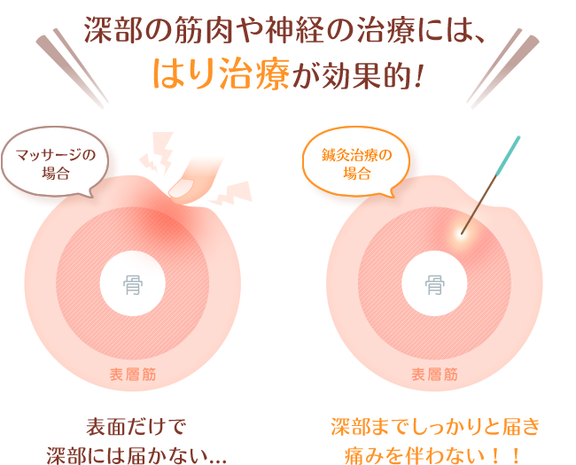 マッサージは表層筋までしか届かないのに対し、鍼は深部の筋肉・神経まで届く様子の図解